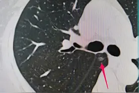 肺腑之言｜非典型性腺瘤样增生，是肺癌吗？图片