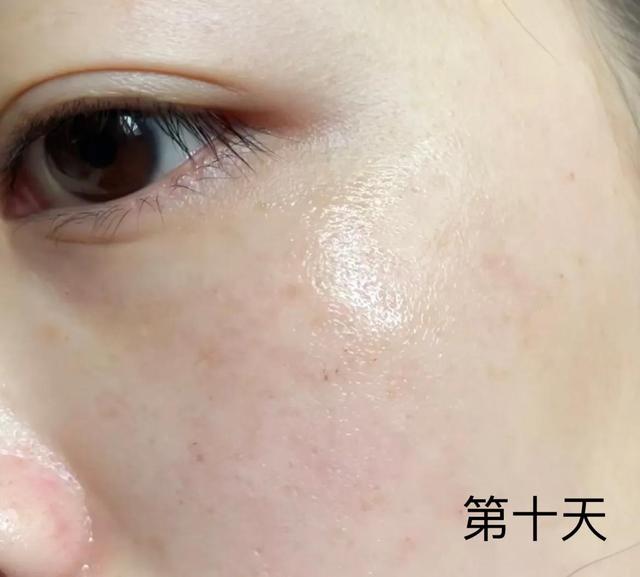 皮秒祛斑后恢复过程（实拍无美颜）