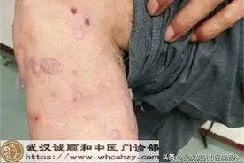 双下肢皮肤长结节肉疙瘩痒得很厉害抓出血才止痒是什么病图片