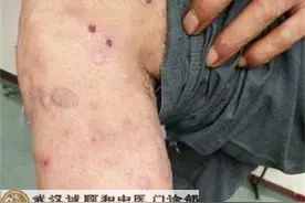 双下肢皮肤长结节肉疙瘩痒得很厉害抓出血才止痒是什么病图片