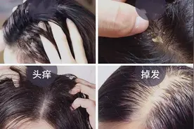 头皮上总长疙瘩是怎么回事？告诉你原因，对症处理消得快图片