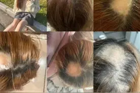 江苏一女子染发后竟然......图片