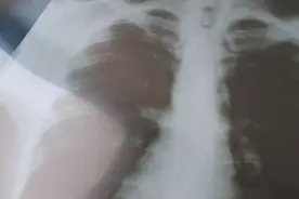 胸口一呼吸就疼痛？一动作找出肋软骨炎消除你的不舒服图片