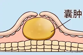 一味中药煮水，化散全身包块、结节、囊肿、息肉图片