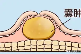 一味中药煮水，化散全身包块、结节、囊肿、息肉图片