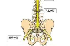最严重的腰突：马尾神经受损！出现这些症状应在48小时内手术图片