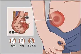 腹股沟疝的临床表现、诊断及治疗图片
