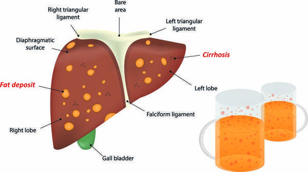 转氨酶升高代表什么？为何它会升高？多半与4个因素有关，别忽视