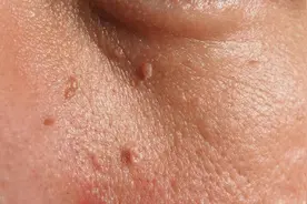 有丝状疣的朋友注意，这件事情少做图片