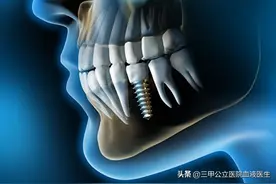 口腔医生绝对不会告诉你种植牙过程中的几点“秘密”图片