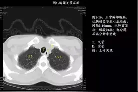 80张图，学会肺CT分段及典型疾病影像图片