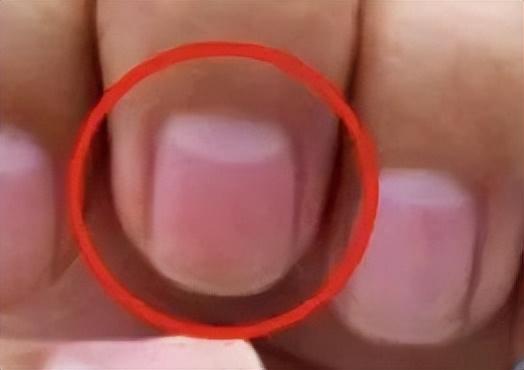孩子指甲这4种表现是患病信号！第1种可能预示肿瘤