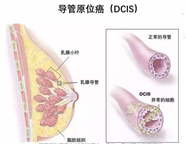联合检查,让乳腺导管原位癌无处可逃