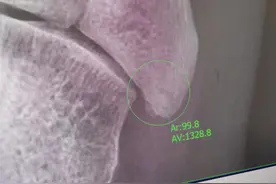 第五跖骨基底部骨折记录第十五天图片