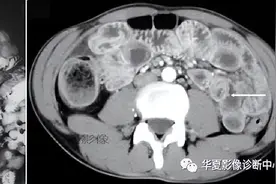 39种腹部典型征象，值得收藏图片