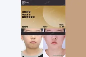 MRC戴了3年，孩子遭罪还没用？！口呼吸面型到底要怎么矫正？图片