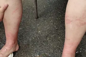 又是因为它！2天内上百人中招，深圳人注意图片