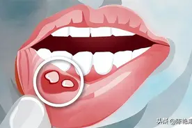 有一种痛，叫口腔溃疡！补充维C不顶用，这些办法更靠谱图片