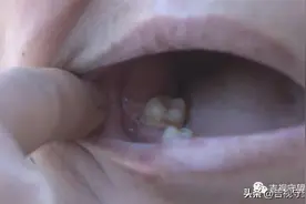 拔牙后症状多，医患纠纷谁之过？图片