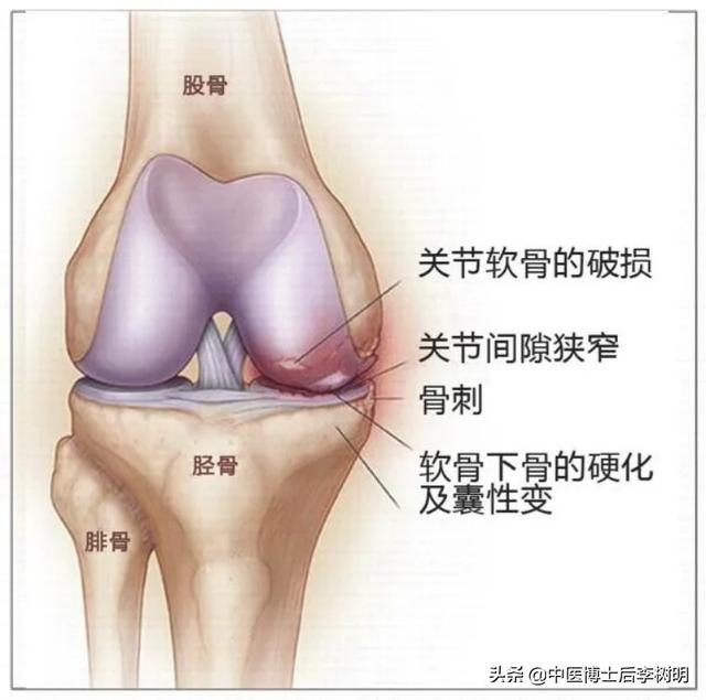 骨关节炎指间关节症状?（得了骨关节炎）