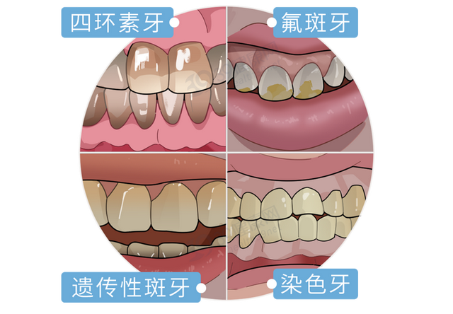 坑了无数人的「牙齿美白骗局」，别再上当了！有效的方法是这3种