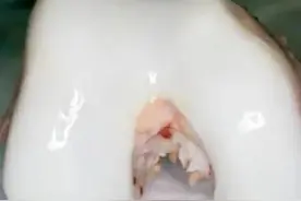 走路不疼，上下楼疼，可能有髌股关节骨关节炎，医生教您自评！图片