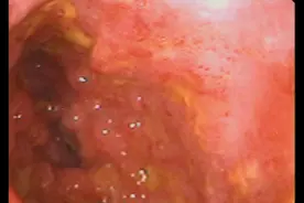 顽固性腹痛竟然是小肠疾病，为什么小肠疾病难以诊断？图片