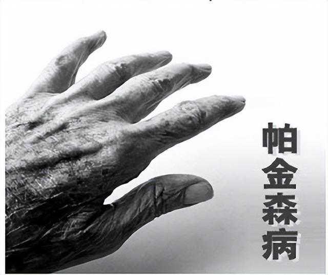 左旋多巴联合盐酸普拉克索药物方案，控制帕金森病