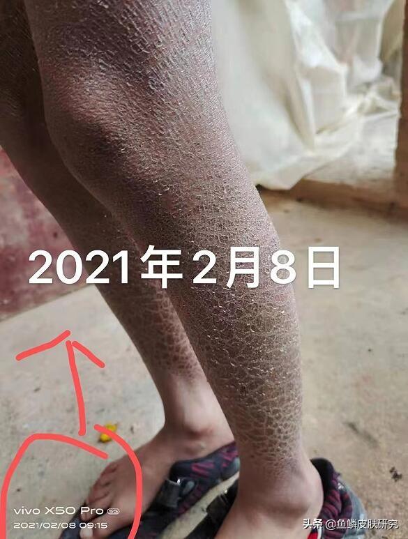 鱼鳞病跟鸡皮肤是一样的时候吗