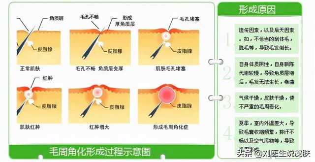 鸡皮皮肤怎么回事啊