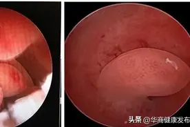 这个常见的妇科疾病，严重起来可能导致不孕图片