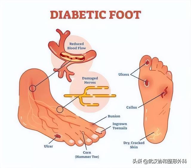 足底过度角化名词解释