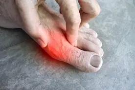 尿酸超标，身体会有3种表现，从这3点入手，可有效降低尿酸值！图片