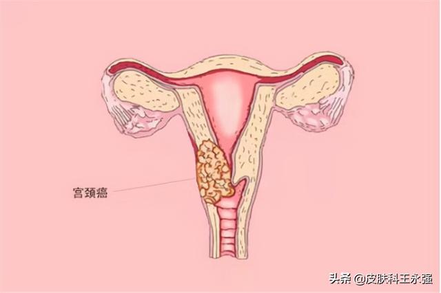 宫颈癌非角化性