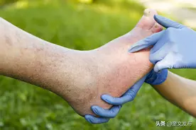 老人总是脚肿？医生：或与这2种疾病有关，家中有老人的都别忽视图片