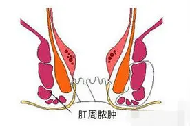 “六亲不认”的肛周脓肿图片