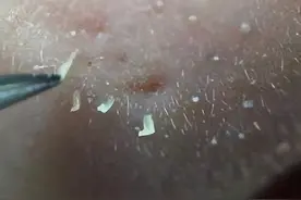 如何去除鼻子上一颗颗的东西？是黑头吗？图片