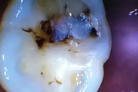 补好牙，你需要知道的那些事图片