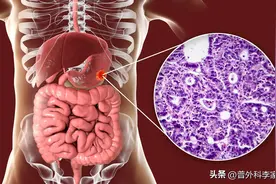 李大夫，胃癌T3N0M0复发率很低，甚至不会复发，对吗？图片