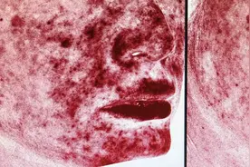 脸遇热发红、皮肤敏感、脸上长痘，原来是玫瑰痤疮在作怪！图片