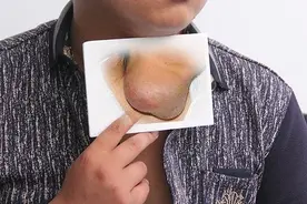肿瘤就是癌症吗？关于肿瘤有几个错误认识，别再误信了图片