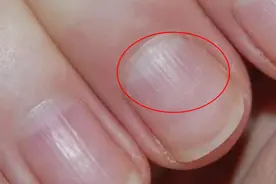 指甲上的竖条纹是身体不健康的信号吗？| No.391图片