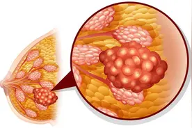乳腺癌为何逐年高发？医生：多半与6大因素有关，女性要学会避开图片