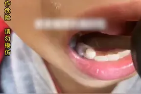 男孩严重蛀牙哭闹不止，爸爸用电钻钻牙止痛：钻了后可以几天不痛，这种小事自己解决就行图片