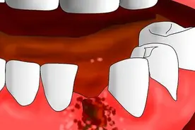 拔牙后血流不止、血块肿大像果冻的要小心了图片