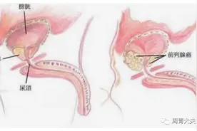 前列腺癌系列专题（一）——走近前列腺癌图片
