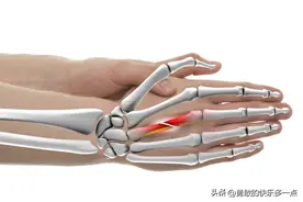 骨折并发症有哪些？您知道吗？图片