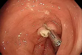 胃肠息肉切除术后应该注意什么？图片