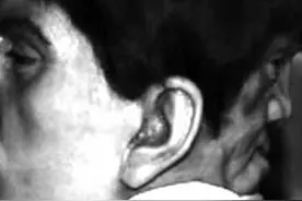 后脑勺上有张脸！世界上真的存在双面人？科学家：罕见但存在图片