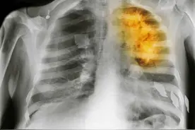 健康早知道：诊断肺癌的检查有哪些？图片